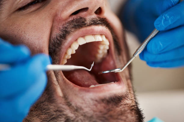 Best Emergency Dental Care for Broken or Chipped Teeth in South Euclid, OH