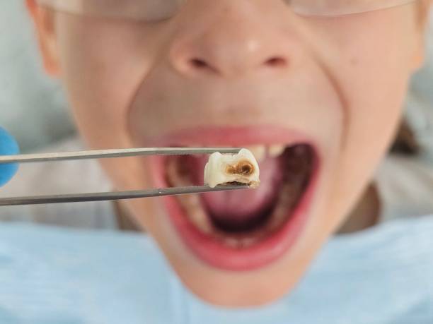 Best Emergency Tooth Extraction in South Euclid, OH